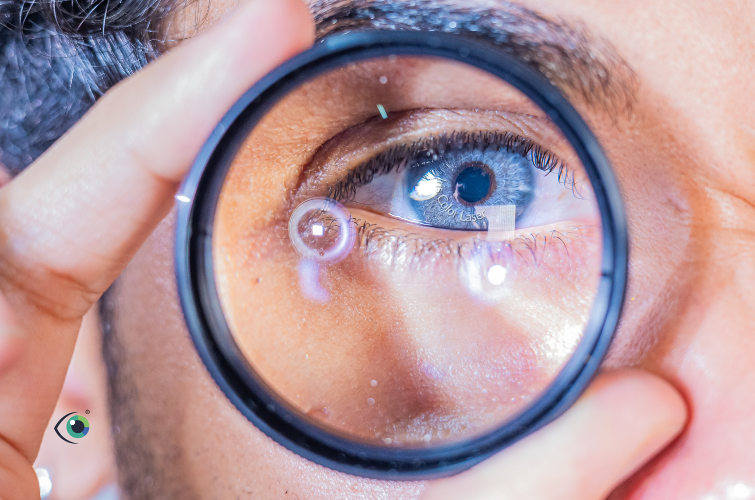 Objetivos del tratamiento con Iris Color Laser®