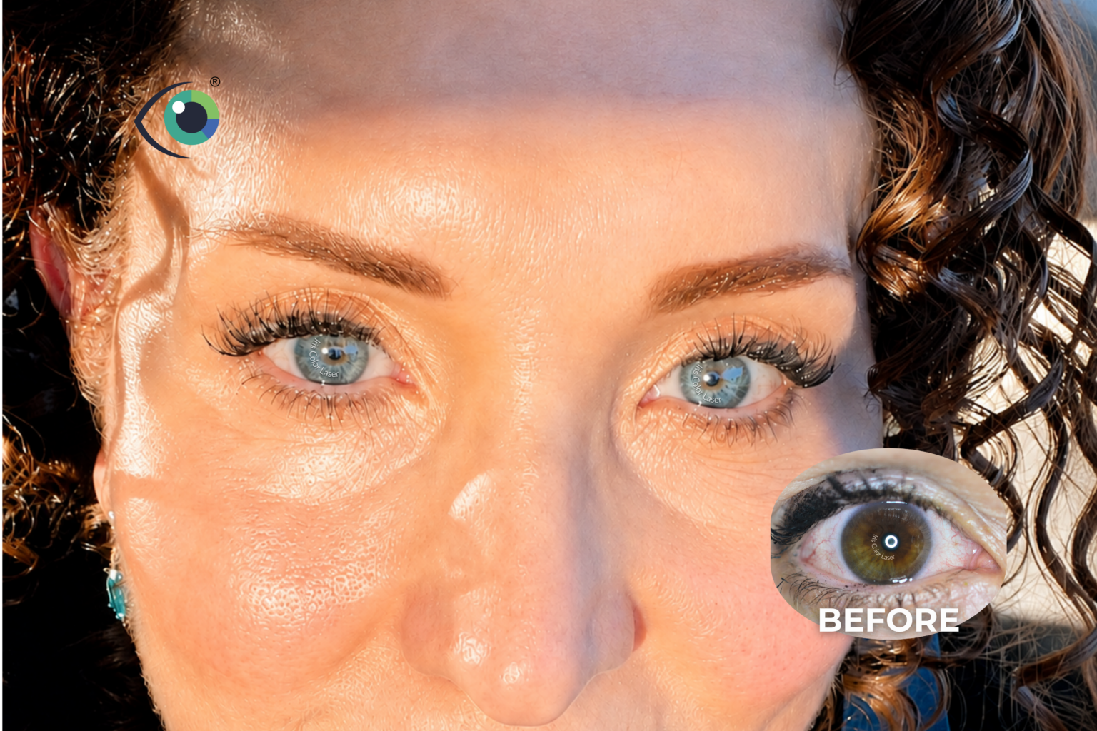 Fotografía clínica de Iris Color Laser